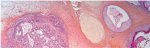 Mixed germ cell tumor