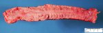 Slight active chronic colitis in Crohn disease