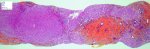 Portal and septal fibrosis in ductal plate malformation (congenital hepatic (...)