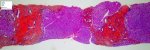Portal and septal fibrosis in ductal plate malformation (congenital hepatic (...)