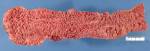 Colonic polyposis. Macroscopy. 2