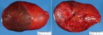 Hepatoblastoma