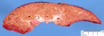 Micronodular cirrhosis in Wilson disease