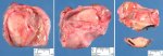Ovarian mature teratoma