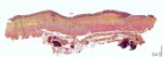 Colonic mucosal ulceration in Hirschsprung disease