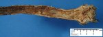 rectal ulceration in Hirschsprung disease