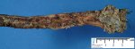 rectal ulceration in Hirschsprung disease