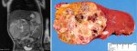 MRI and macroscopy of the same case of hepatoblastoma