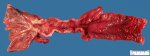 Crohn ileitis (Ileal Crohn disease)