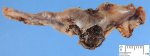 Ectopic tubal pregnancy
