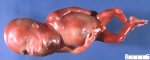Cervical teratoma (21 weeks)