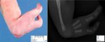 Radial agenesis with ectrodactyly