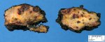 Complex vascular malformation (complex vascular dysplasia)