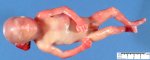Posterior encephalocele