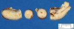 Appendiceal lymphoid hyperplasia