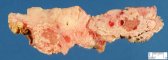 Acute necrotizing pancreatitis