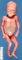Facial dysmorphism in holoprosencephaly sequence (case 12063)