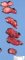 Thyroid papillary carcinoma