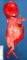 Megacystis sequence by urethral obstruction (17 weeks) (Case (...)