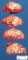 Hepatic granulomatosis in a systemic fungal infection