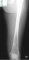 Femoral osteosarcoma (Case 12617)