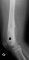 Case 11734: Femoral osteoblastic osteosarcoma