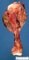 Femoral osteosarcoma
