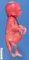 Megacystis sequence from urethral atresia in Vater association