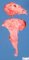 Hydronephrosis