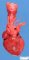 Preductal aortic coarctation