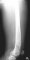 Femoral osteosarcoma (Case 12617)