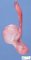 Testicular endodermal sinus tumor (Yolk sac tumor)