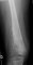 Case 11734: Femoral osteoblastic osteosarcoma