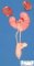 Horseshoe kidney (Fetus, 20 weeks)