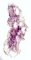 Megacystis, bilateral obstructive multicystic renal dysplasia (BOMRD) with (...)