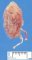 Ureteral duplication with obstructive renal dysplasia
