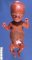 Micromelic dwarfism in thanatophoric dysplasia