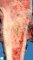 Femoral Ewing sarcoma