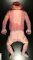 Anencephaly (40 weeks)