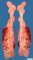 Femoral osteosarcoma