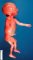 Humeral meromelia (fetus, 21 weeks)