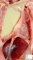 Pleural empyema