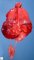 Uniateral renal agenesis in a malformative syndrome