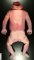 Anencephaly (40 weeks)