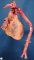 Dissection of proximal ascending thoracic aorta in Marfan disease