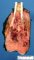 Femoral osteoarcoma