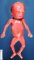 Fetal hydrocephaly (21 weeks)