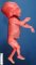 Fetal hydrocephaly (21 weeks)