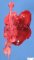 Left diaphragmatic hernia (fetus, 25 weeks)