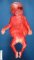 Posterior encephalocele in Meckel syndrome